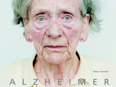 Πρόοδος στην έρευνα για το Αλτσχάιμερ;