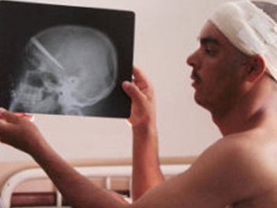 Ζούσε με καρφωμένο μαχαίρι στο κεφάλι επί τρία χρόνια Ζούσε με καρφωμένο μαχαίρι στο κεφάλι επί τρία χρόνια