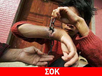 Το δέρμα του «ενσωμάτωσε» τις αλυσίδες με τις οποίες ήταν δεμένος