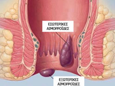 Αιμορροϊδοπάθεια: Οριστική θεραπεία