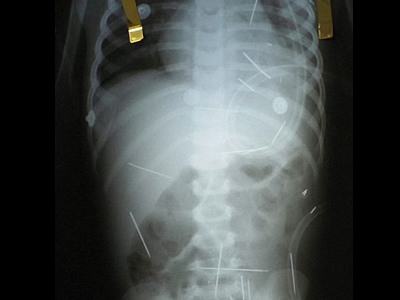 Κάρφωσαν 50 βελόνες σε 2χρονο αγοράκι