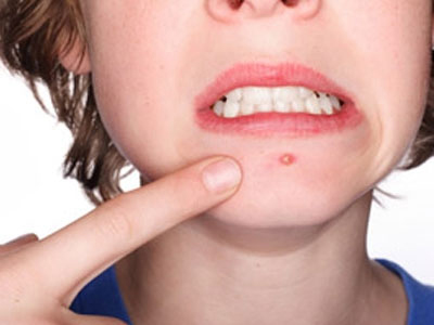 Το άγχος βγάζει… σπυράκια