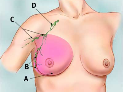 Ορμονοθεραπεία για τον καρκίνο του μαστού