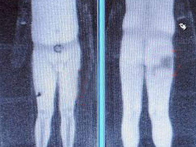 Τον έδειρε επειδή τον χλεύαζε για το μικρό πέος του