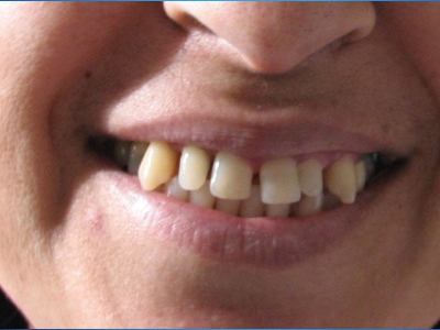 Συνένζυμο Q10 και περιοδοντίτιδα