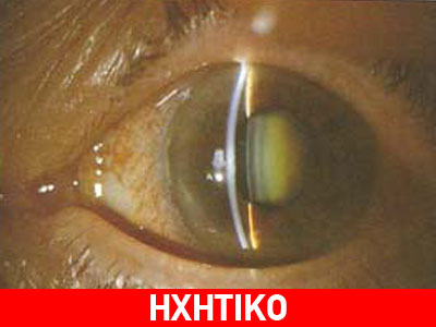 Οφθαλμίατρος χειρουργεί αν και πάσχει από Πάρκινσον