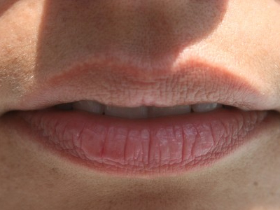 Τρόποι για να μαλακώσετε τα σκασμένα χείλια