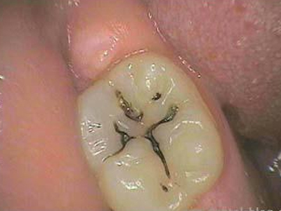 Τι είναι η τερηδόνα