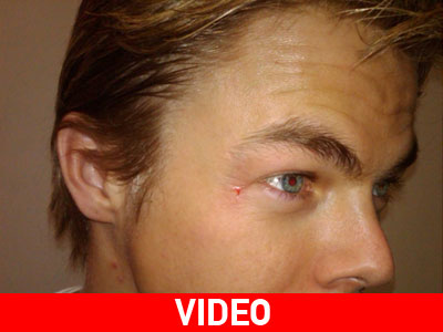 Το ατύχημα του Derek Hough Το ατύχημα του Derek Hough