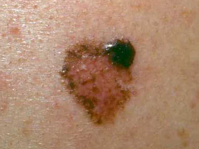 Μελάνωμα, ένας ύπουλος εχθρός