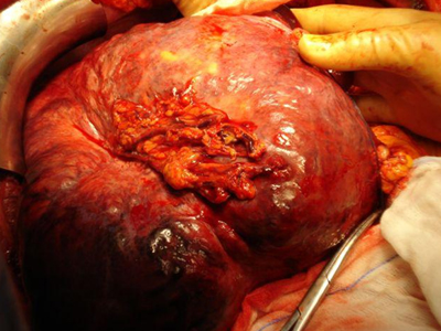 Όγκος 4,5 κιλών αφαιρέθηκε από 43χρονο άνδρα