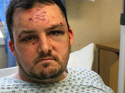 Κλέφτης άφησε την ”ταυτότητά” του στο μέτωπο του θύματος