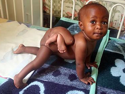 Κουβαλά στους γοφούς το αγέννητο αδερφάκι του