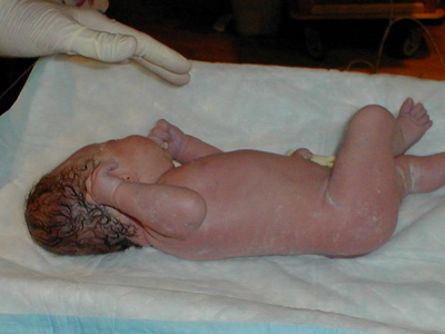 Βρέφος 5,25 κιλών με φυσιολογικό τοκετό!