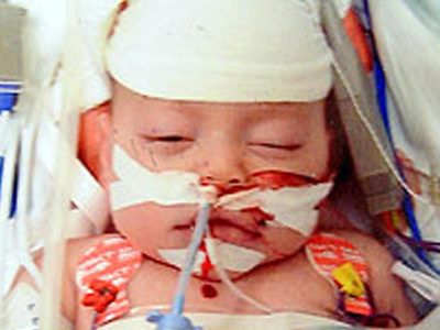 Βρέφος εθισμένο στην ηρωίνη πέθανε έχοντας 13 σπασμένα πλευρά