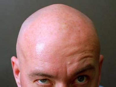 Η φαλάκρα είναι γονιδιακή και μπορεί να προβλεφθεί