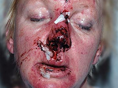 Το «πρόσωπο» της ενδοοικογενειακής βίας