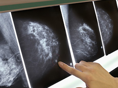 Αφαίρεσαν από καρκινοπαθή τον υγιή μαστό