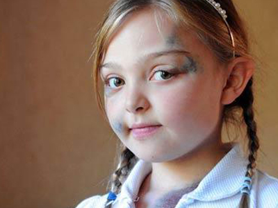 Μυστήριο με το κορίτσι που μελανιάζει