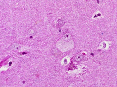 H νόσος Niemann – Pick τύπου C