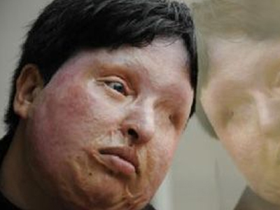 Οφθαλμός αντί οφθαλμού στην κυριολεξία