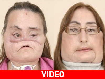 Η ”αποκάλυψη” της πρώτης Αμερικανίδας που έκανε μεταμόσχευση προσώπου