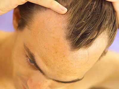 Φαλάκρα τέλος!