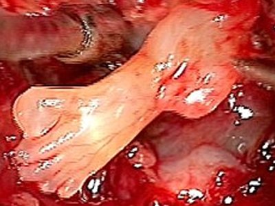 Πόδι αναπτυσσόταν σε κεφάλι νεογέννητου