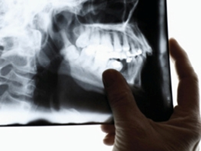 Της έβγαλαν σφαίρα από το κεφάλι μετά από 42 χρόνια