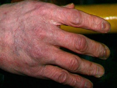 Τα άσχημα χέρια του Μάικλ Τζάκσον