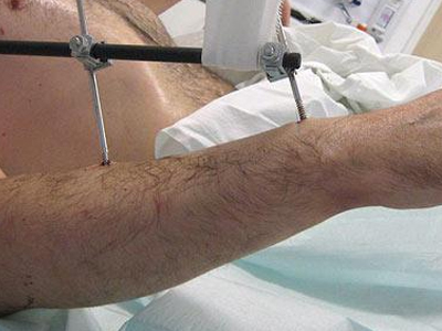 Του έκαναν μεταμόσχευση χεριών