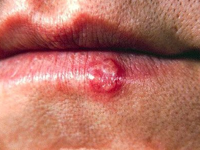 Τα μυστικά του επιχείλιου έρπητα