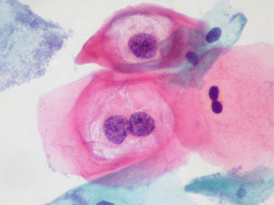 HPV – ο πιο συχνός ιός του γεννητικού συστήματος και το εμβόλιο κατά του καρκίνου του τραχήλου