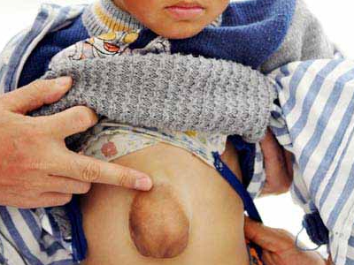 Καρδιά 4χρονου μεγαλώνει στο στομάχι του