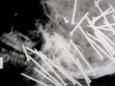 Τον ”πυροβόλησαν” με 34 καρφιά στο κεφάλι