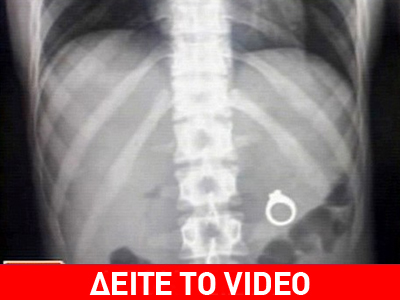 Κατάπιε το δαχτυλίδι των αρραβώνων της