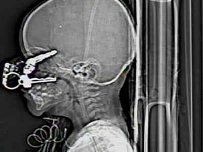 Του καρφώθηκαν κλειδιά στο μάτι