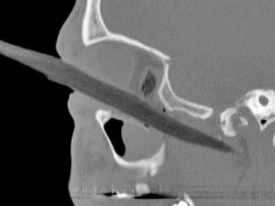 Του καρφώθηκε κλαδί στο μάτι