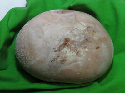 «Κοτρώνα» στα νεφρά