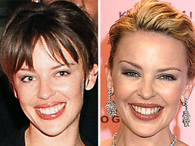 Η Κάιλι παραδέχτηκε πως έκανε «botox»