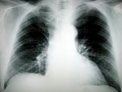 Η γονιδιακή πρόγνωση στη μάχη κατά του καρκίνου του πνεύμονα