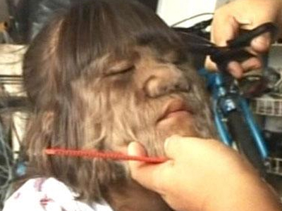 Ψάχνουν θεραπεία για το αγόρι – λυκάνθρωπο