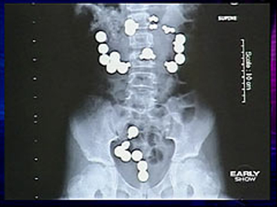 Κατάπιε 30 μαγνήτες από παιχνίδι