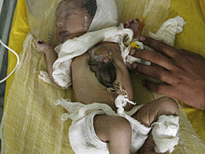 Γεννήθηκε με την καρδιά έξω από το στήθος