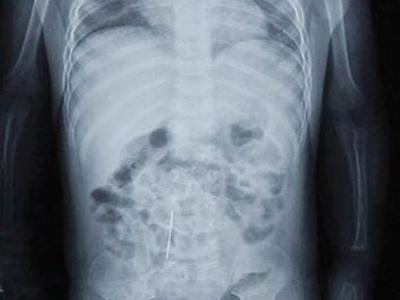 Πρόστιμο «μαμούθ» στο γιατρό που ξέχασε βελόνα μέσα σε ασθενή