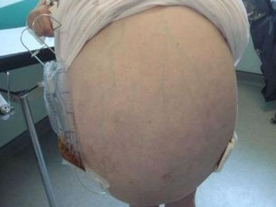 Απαλλάχτηκε από όγκους βάρους 29 κιλών!