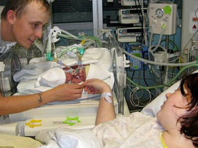 Κατέληξε το ένα από τα σιαμαία