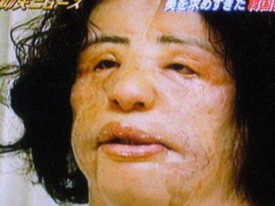 Παραμορφώθηκε κάνοντας ένεση λαδιού