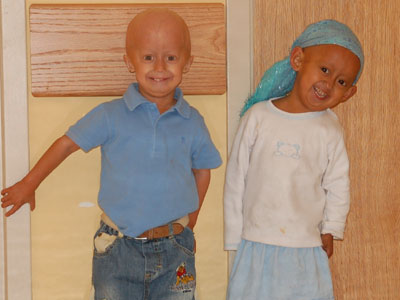 Προγερία: Το σύνδρομο Hutchinson-Gilford