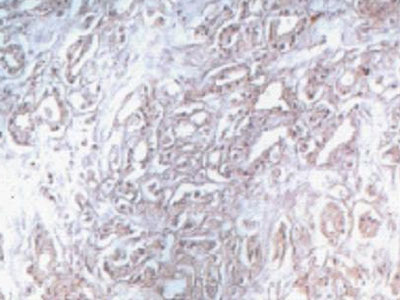 Νέο τεστ για τον καρκίνο του προστάτη